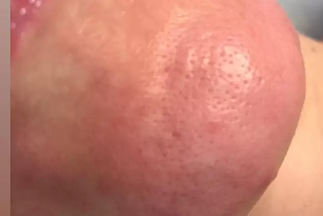 После процедуры фото №4