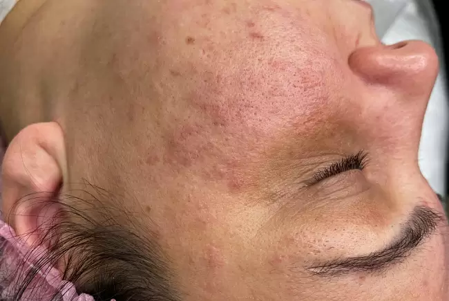 После процедуры фото №1