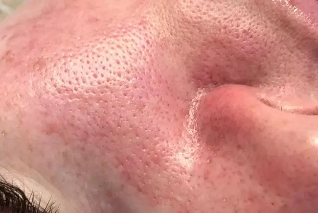 После процедуры фото №3