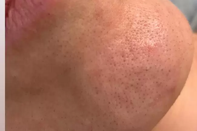 До процедуры фото №4