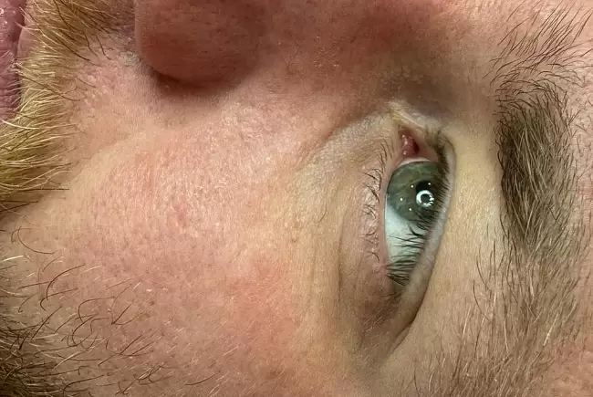 После процедуры фото №2