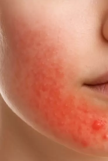 Лечение инфекционных заболеваний кожи